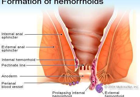 hemoroīdi