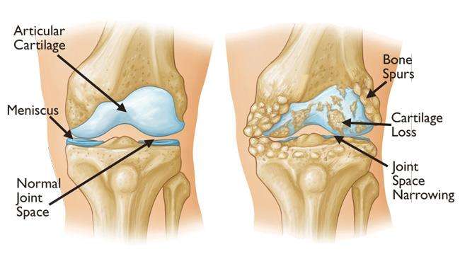 osteoartritis i njegov forum liječenje krema od bolova u zglobovima