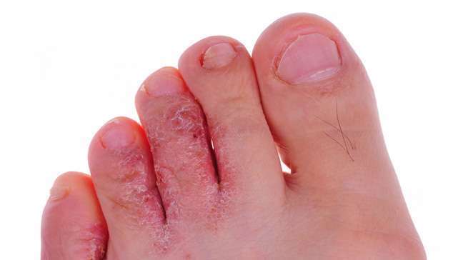 Co je plísňová infekce nohou